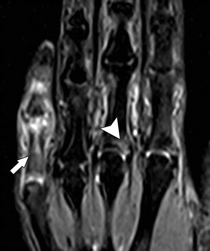 Differentiating Rheumatoid And Psoriatic Arthritis Of The Hand