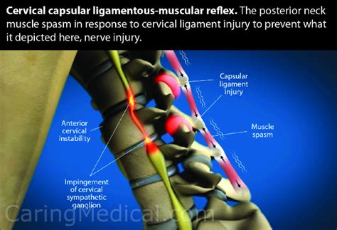 Cervical Vertigo And Cervicogenic Dizziness Neck Pain And Dizziness