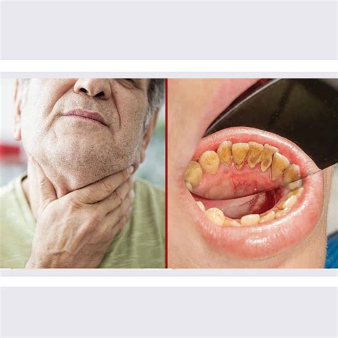 oral cancer symptoms warning signs