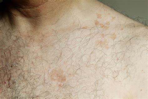 Tinea Versicolor Treatment Before And After