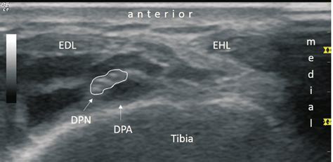Deep Peroneal Nerve At The Level Of The Ankle Dpa Dorsalis Pedis