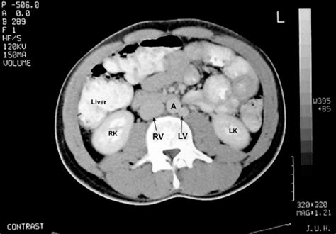 Axial Ct Scan Of The Abdomen A Aorta Rv Right Vena Cava Lv Left