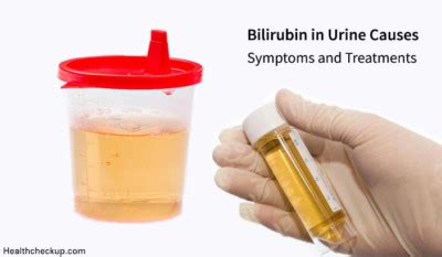 Bilirubin In Urine Causes Symptoms And Treatments Bilirubin Levels