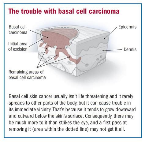 Basal Cell Carcinoma Diagnosis And Treatment Dermatology Surgery My