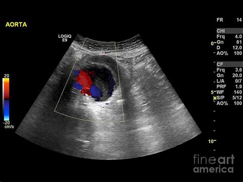 Abdominal Aorta Ultrasound