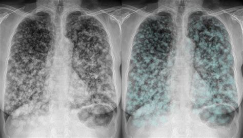 Chest X Ray Lung Cancer Metastases To Lung