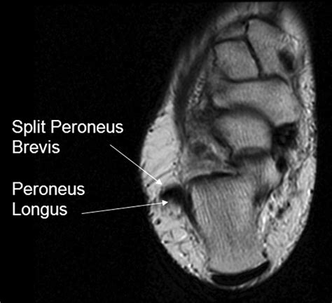 Split Peroneus Brevis Tendon An Unusual Cause Of Ankle Pain And