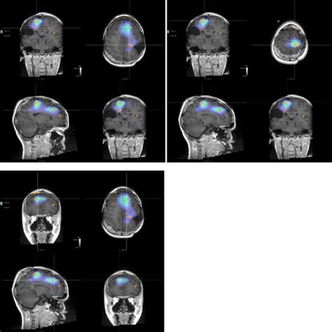 Post Surgical Mri With Superimposition Of Ct Sequences For Seeg