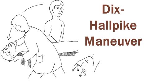 Dix Hallpike Test Dix Hallpike Maneuver Youtube