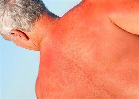 What Are The Signs Of A Sunscreen Allergy With Pictures