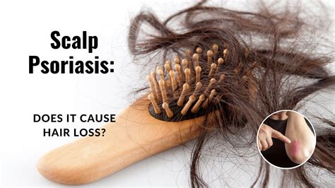 Scalp Psoriasis Does It Cause Hair Loss Hanna Sillitoe