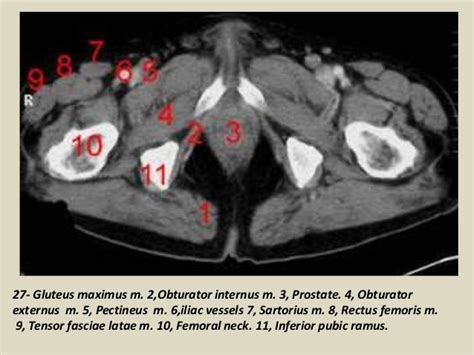 Ct Pelvis Anatomy Muscles Pelvic Floor Muscles Anatomy Ct Review