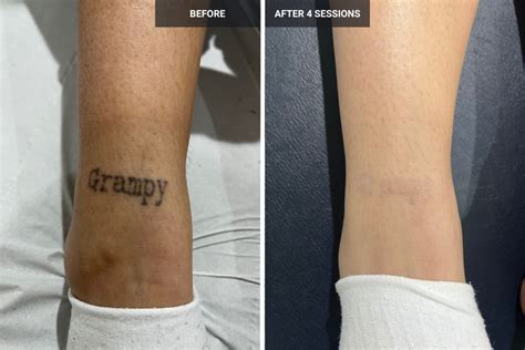 Before And After Tattoos