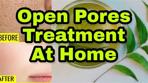 Open Pores Treatment At Home How I Treat My Open Skin Pores