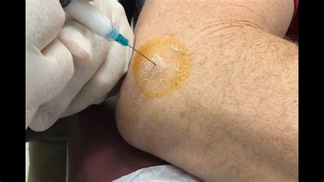 Tennis Elbow Cortisone Injection Epicondylitis Treatment For Marco