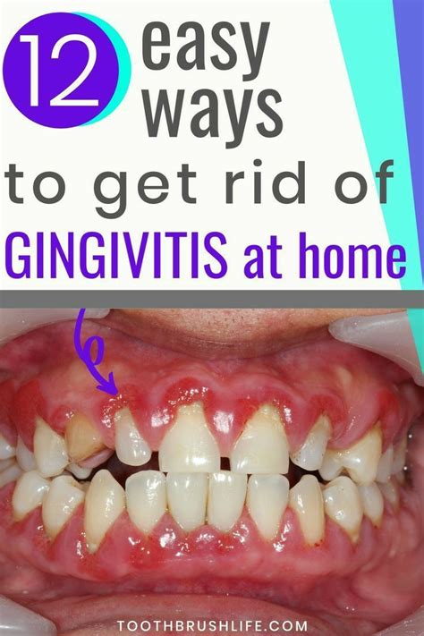 How To Get Rid Of Gingivitis At Home Fast And Naturally In 2020 With