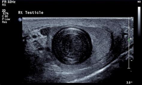 Intratesticular Epidermoid Cyst Radiology Case