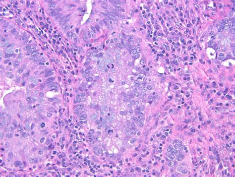 Pathology Outlines Hpv Associated Adenocarcinoma Usual Type And