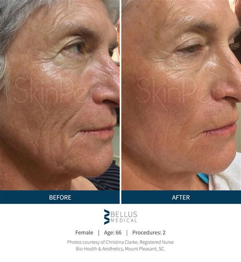 microneedling madrona dermatology