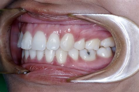 Dan inilah hasil sebelum dan selepas. perubahan gigi setelah memakai braces