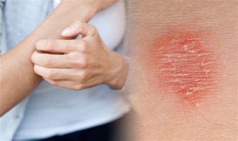 The rashes can show up all over the body, in multiple areas, or in a specific place. Itchy skin: Four causes of irritation if you also have a ...