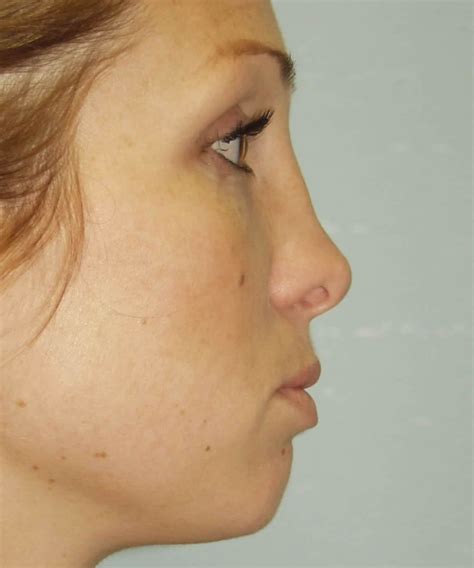 Rhinoplasty Surgery For Saddle Nose Deformity In San Diego Ca Dr