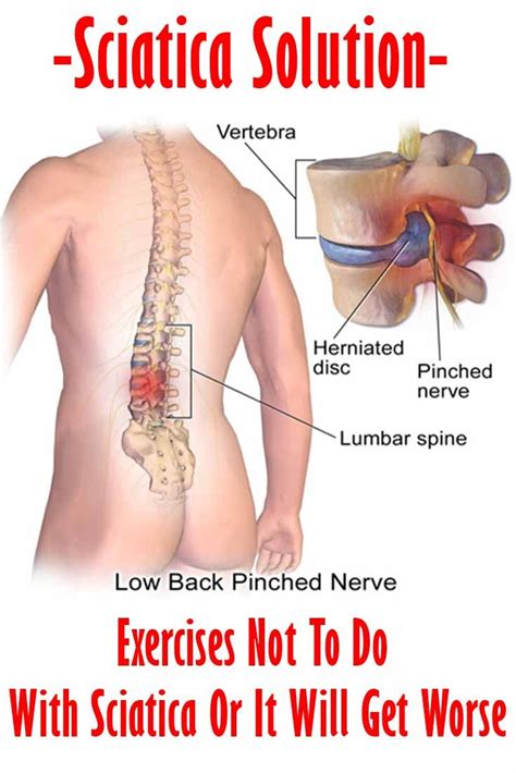 Nc is worse walking downhill (the back is arched) and leaning back. 706 best images about sciatica on Pinterest | Si joint ...