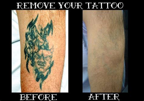 Лазерно премахване на татуировки Inside Ink Tattoo Studio