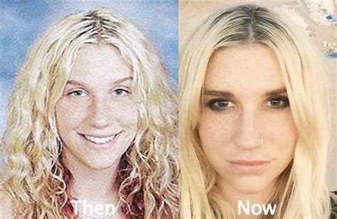 Kesha Plastic Surgery Before And After Photos