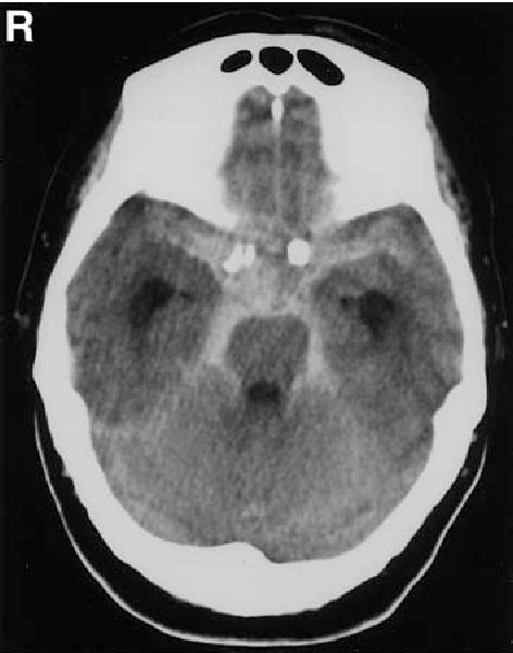 Figure 2 From Intracranial Atypical Fibromuscular Dysplasia With
