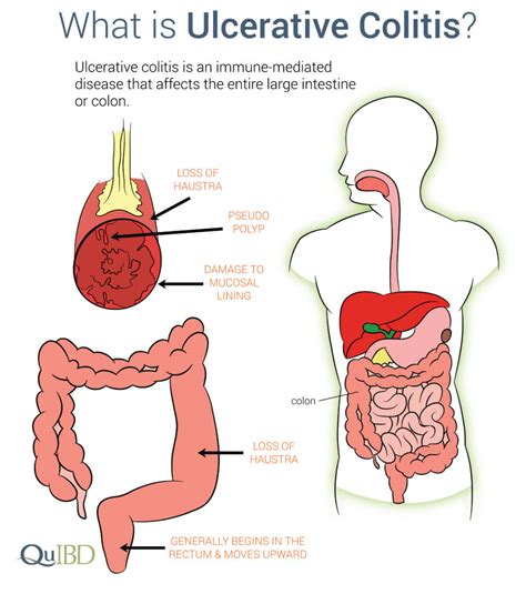 Ulcerative Colitis Symptoms IBD Prevalence Impact Causes