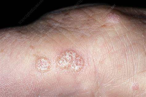 Warts On The Hand Stock Image C0213421 Science Photo Library