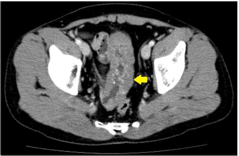 Preoperative Computed Tomography Ct Scan Contrast Enhanced Abdominal