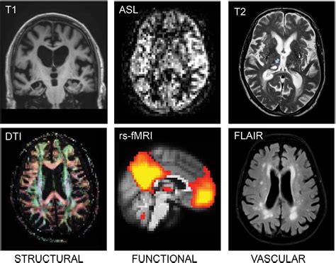 Secondary Prevention Of Alzheimers Dementia Neuroimaging