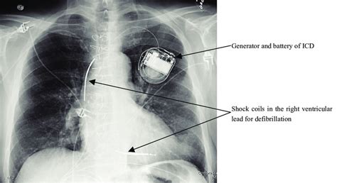 Chest X Ray Demonstrating The Leads Of Icd With Two Translucent