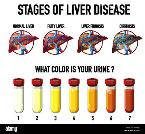Stages Of Liver Disease Illustration Stock Vector Image And Art Alamy