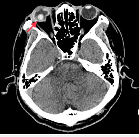 Axial Cut Of Ct Scan Shows Right Globe Rupture With Posteriorly