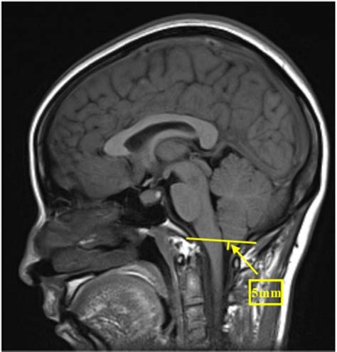 Typical Mri Manifestation Of Brain Sagging Midsagittal Open I