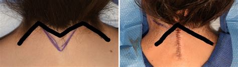 Plastic Surgery Case Study Correction Of The Webbed Neck With