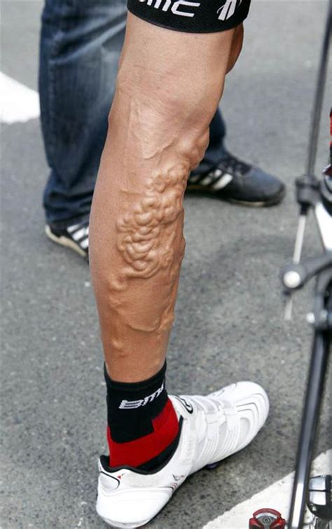 He didn't make the cut for this year's tour. What is wrong with this Tour de France cyclist's leg?! - NBC News