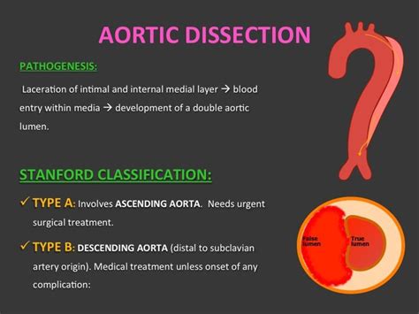 Medical School Aortic Dissectionwhat To Know Aortic Dissection