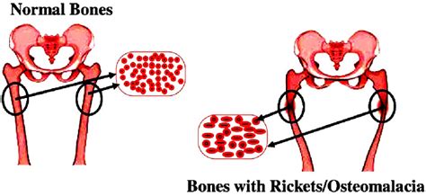 Bone With Ricketsosteomalacia Skeletal Muscle Soreness And
