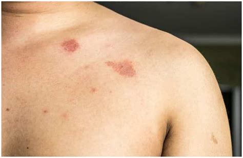 Nummular Eczema Vs Ringworm Symptoms Causes Diagnosis Treatment