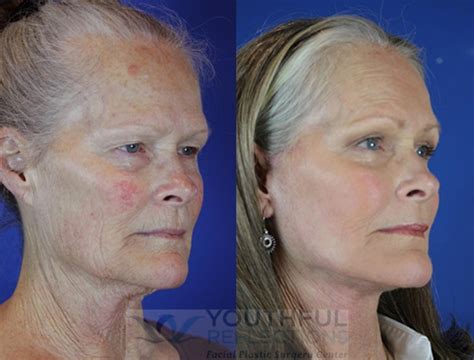 Facelift Reflection Lift Before And After Photos Patient 24 Nashville Tn Youthful Reflections