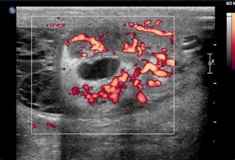 Testicular Abscess Radiology Case Diagnostic Medical Sonography Radiology