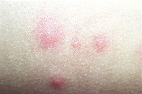 How To Identify These Common Bug Bites Reader S Digest