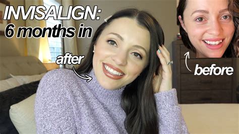 The Truth About Invisalign Before After 6 Months Faq Answered