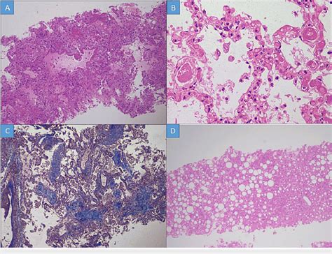 Histopathological Changes In The Lung A Deep Eosinophilic Hyaline