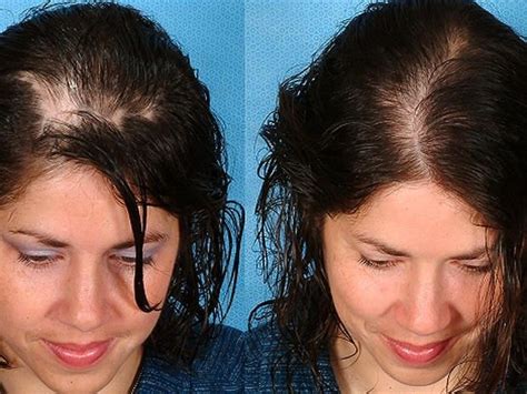 Hair Transplant Preparedness Tips Turkey Hair Transplant Package