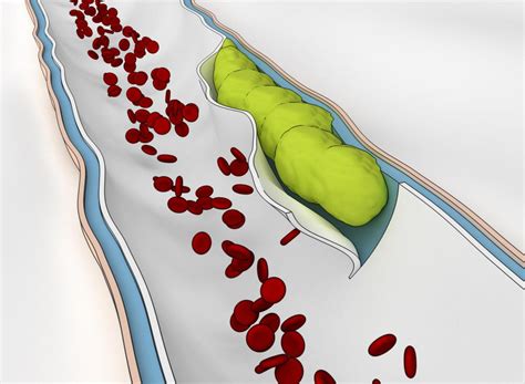 Small Vessel Ischemic Disease Cerebral Csvd Vascular Svn Bmj Diseases